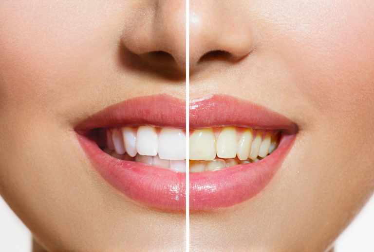 teeth whitening treatment