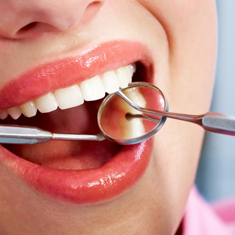 Close-up of a dental crown restoration on a patient tooth at Riverfront Dental in Cambridge Ontario