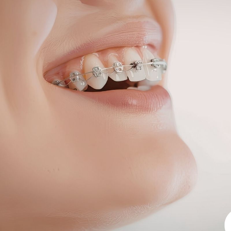 Clear Braces Orthodontic Treatment Riverfront Dental Cambridge Ontario