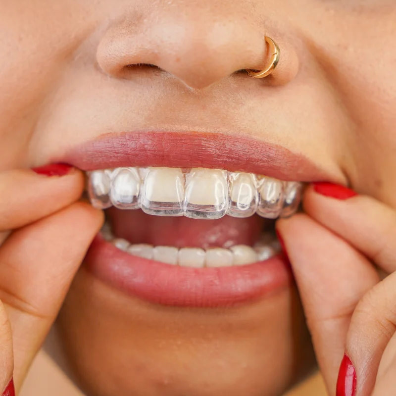 Close-up of a patient placing clear Invisalign aligners on teeth for orthodontic treatment at Riverfront Dental in Cambridge Ontario