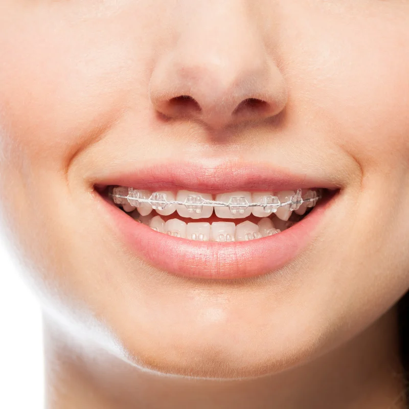 Close-up of a patient smiling with clear orthodontic braces used to straighten teeth at Riverfront Dental in Cambridge Ontario
