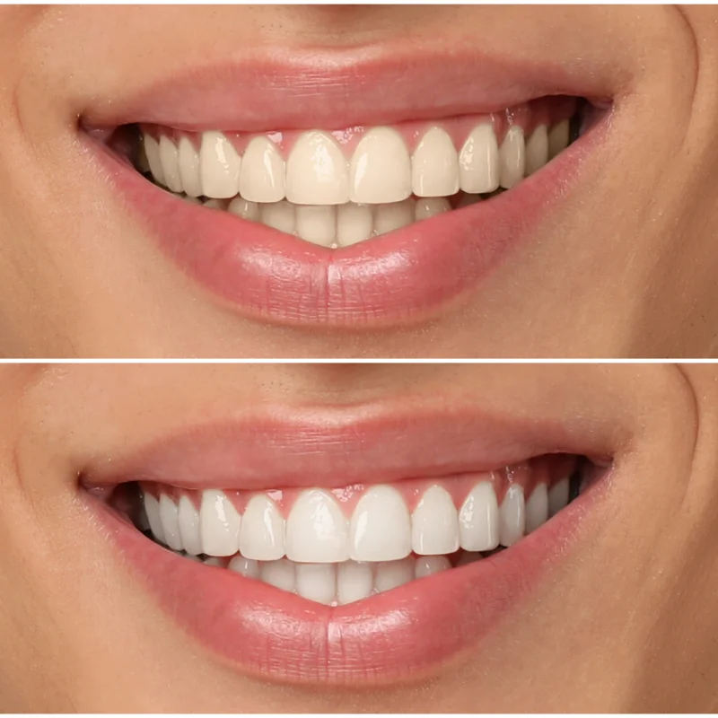 Before and after comparison showing brighter teeth after professional teeth whitening treatment at Riverfront Dental in Cambridge Ontario